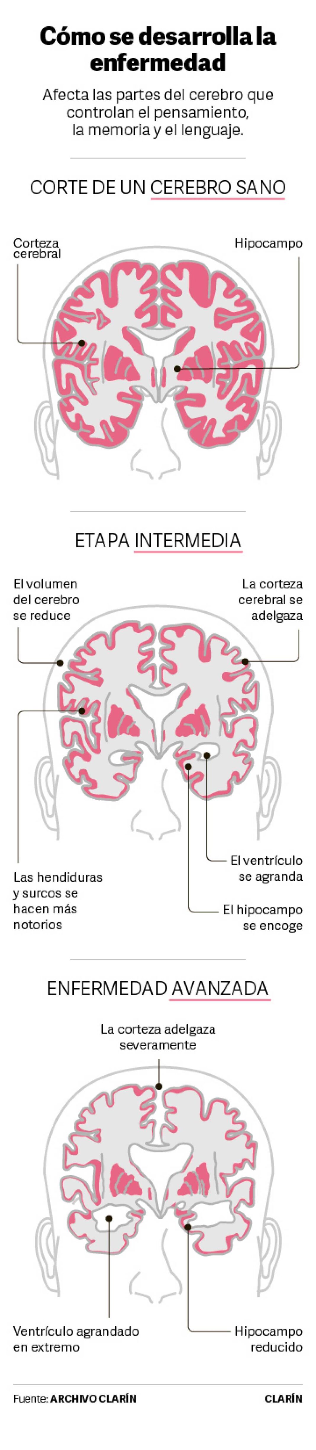 por-primera-vez-logran-identificar-variantes-geneticas-que-pueden-predecir-el-alzheimer-en-los-argentinos